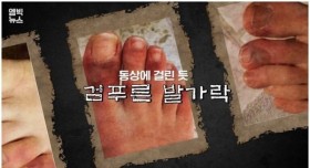 코로나19 피부 괴사까지 일으킨다!!