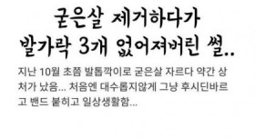 굳은살 제거하다가 발가락 3개 없어져버린 썰